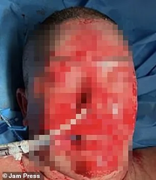 Femme de 42 ans hospitalisée au Brésil après réaction grave à la lamotrigine