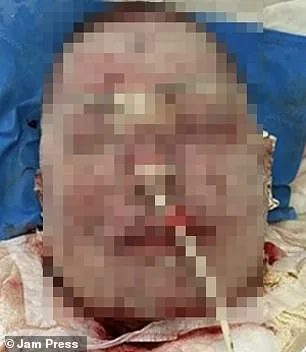 Femme de 42 ans hospitalisée au Brésil après réaction grave à la lamotrigine