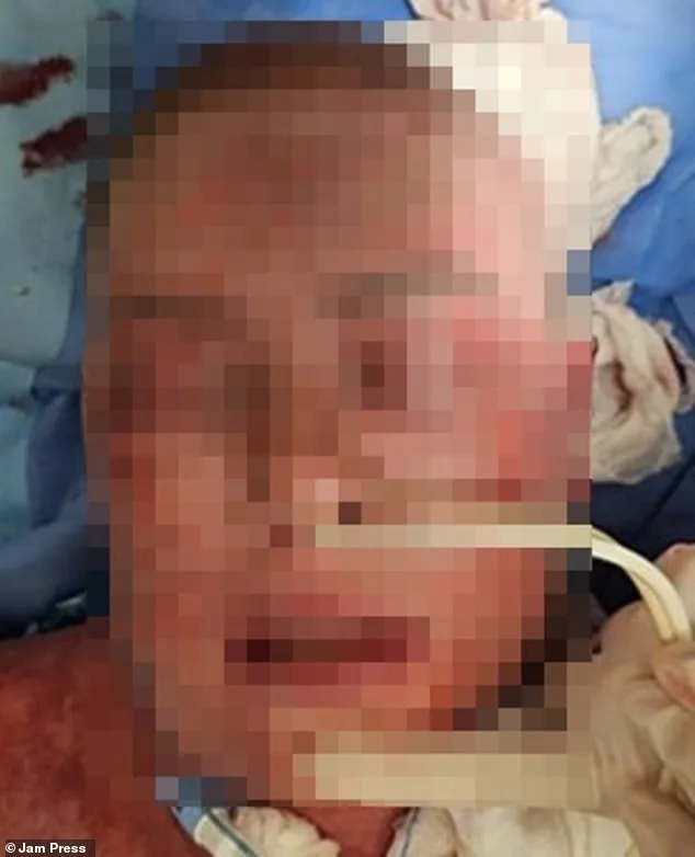 Femme de 42 ans hospitalisée au Brésil après réaction grave à la lamotrigine