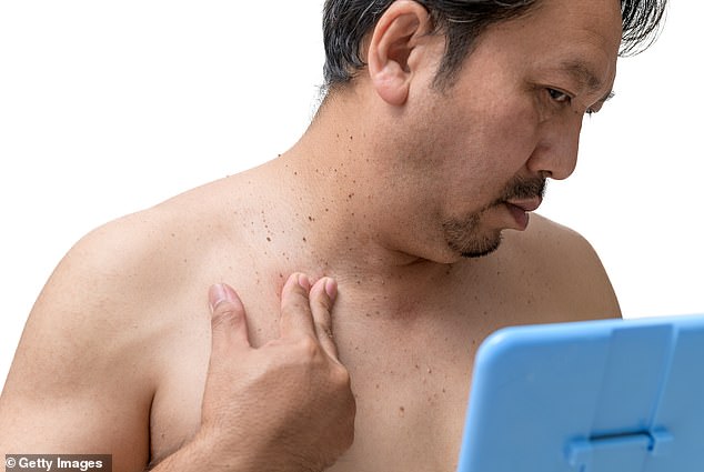Skin Tags May Signal Hidden Metabolic Risks Like Diabetes