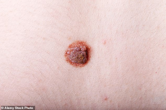 Global skin cancer cases could surge by 2050, with deadly melanoma rising sharply.