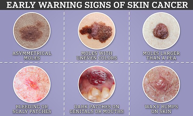 Global skin cancer cases could surge by 2050, with deadly melanoma rising sharply.