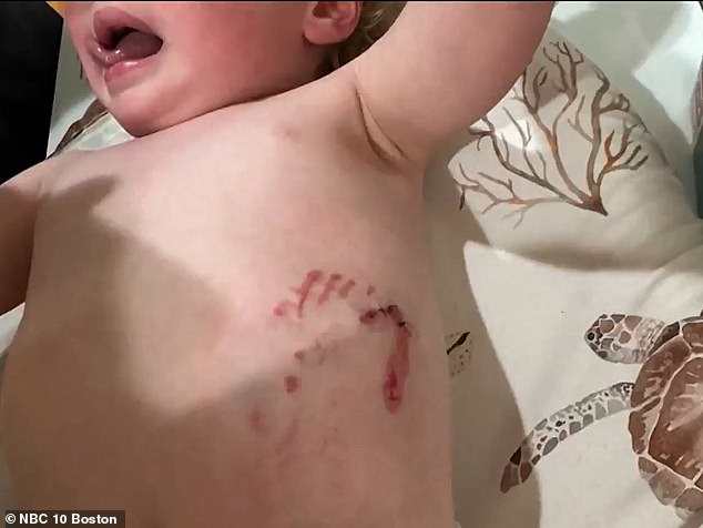Massachusetts toddler suffers severe raccoon attack on suburban playground.
