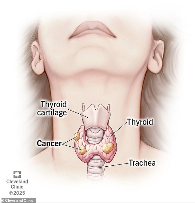 Persistent Hiccups Warned California Man of Deadly Cancer Years Later