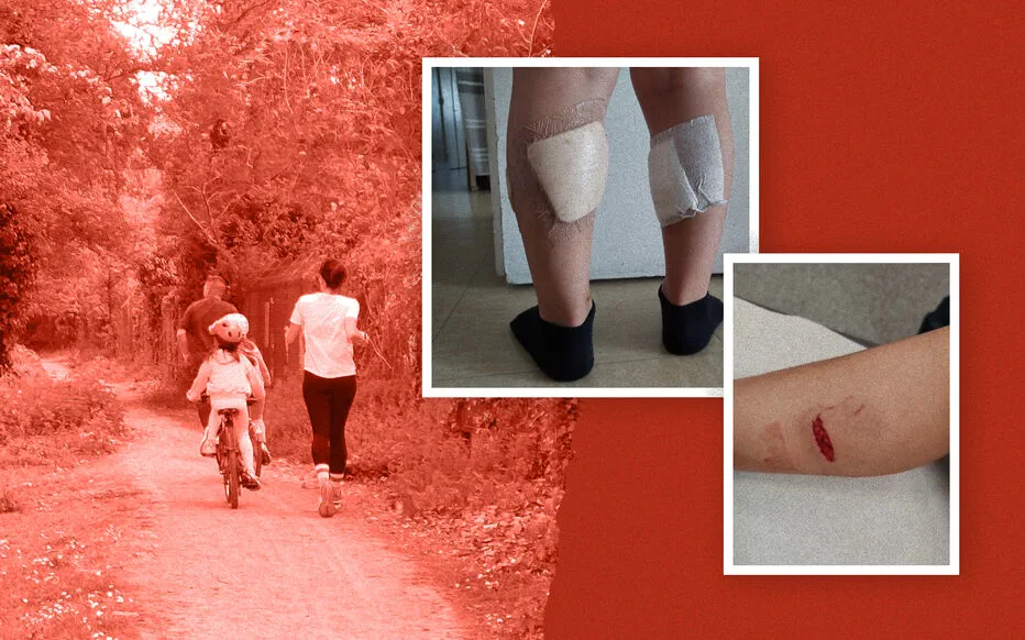 Naël, un jeune garçon de 5 ans, vit encore les conséquences d'une morsure de chien.