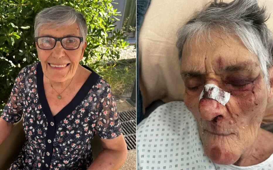 Le visage contusionné de Jeanine révèle les négligences de l'Ehpad Les Oliviers-de-Saint-Jean